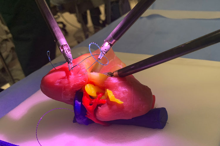3D printed kidney model used by robotic urologic oncology surgeon Medical